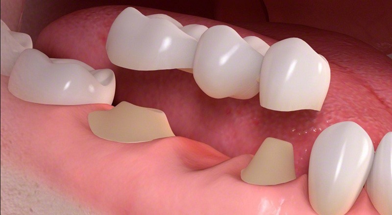 Trồng răng nhai bằng phương pháp cầu răng sứ