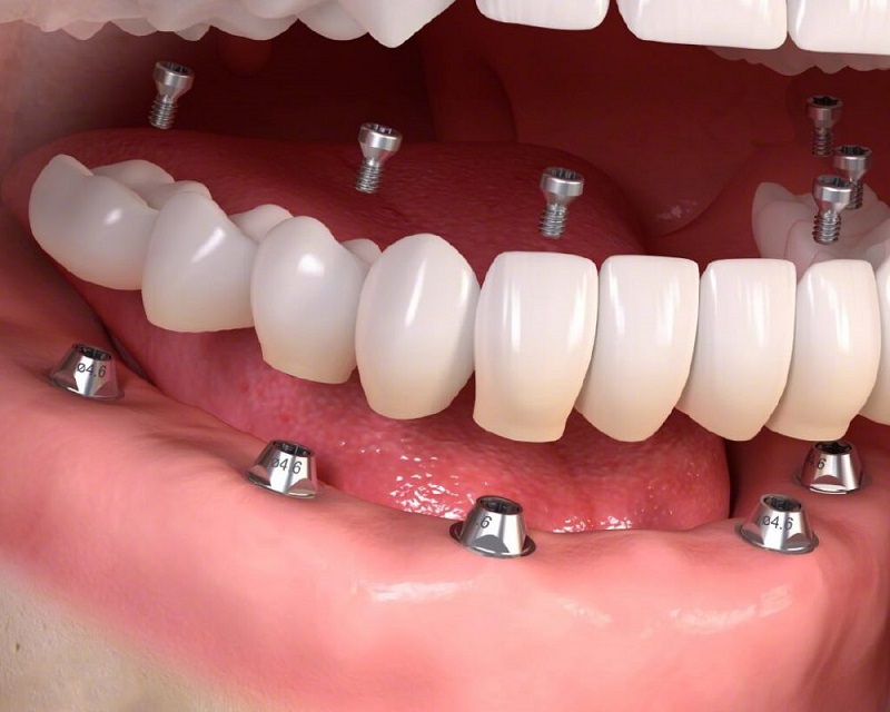 Trồng răng nhai là phương pháp giúp phục hình lại chiếc răng bị mất