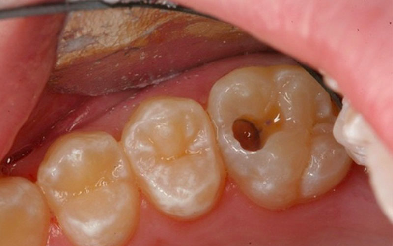 Tình trạng chết tủy làm gia tăng nguy cơ mất răng vĩnh viễn