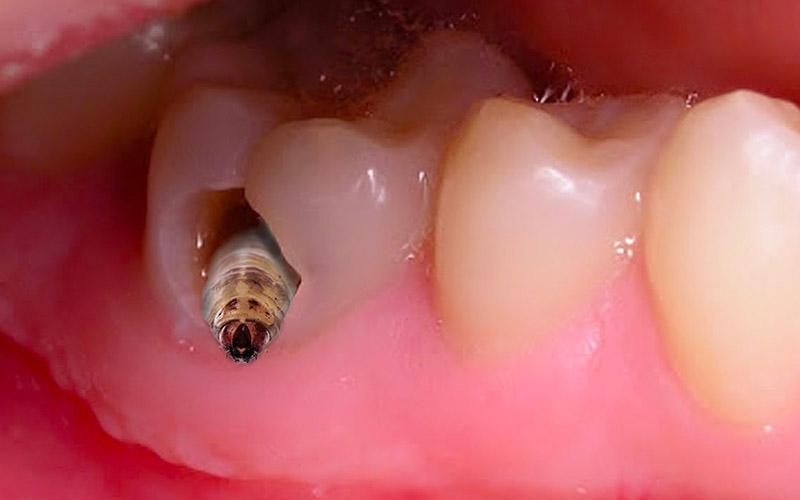 Sâu răng tạo điều kiện để vi khuẩn tấn công, gây viêm tủy răng