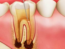 Tủy Răng: Chức Năng, Cấu Tạo Và Những Vấn Đề Thường Gặp