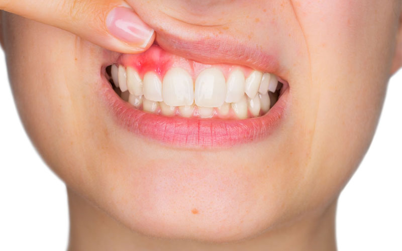 Đây là bệnh lý về sự tổn thương các tổ chức quanh răng và chân răng