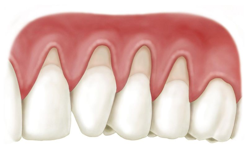 Viêm nướu răng sứ là tình trạng khiến nhiều người lo lắng
