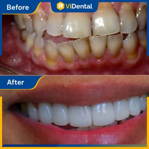 Chị Lê Thảo Anh nhận về kết quả hài lòng sau khi trải nghiệm dịch vụ bọc răng sứ tại ViDental Clinic