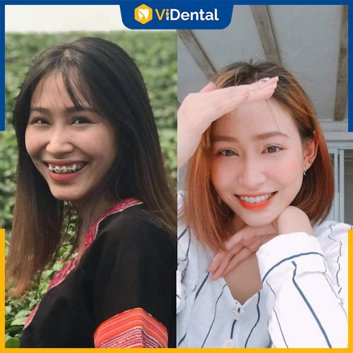 Chị Khánh Linh rất hài lòng sau khi niềng răng trainer tại Vidental