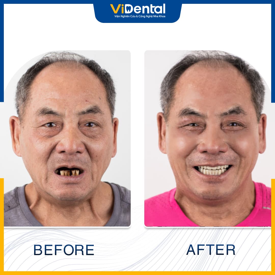 Mất răng, răng hư hỏng phải nhổ nên trồng răng sứ để khắc phục