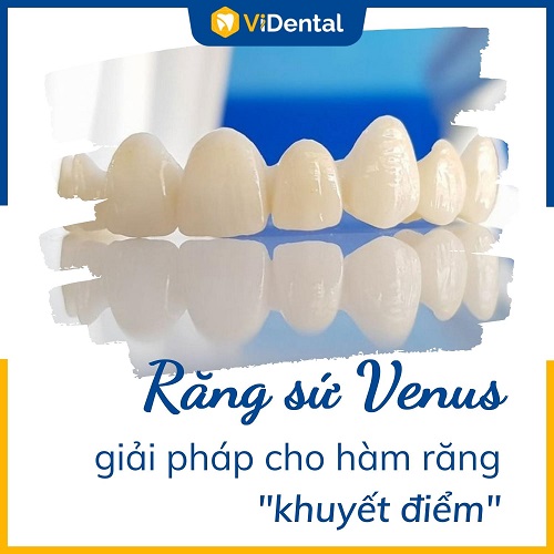Răng sứ Venus là dòng sản phẩm sử dụng 100% sứ cao cấp