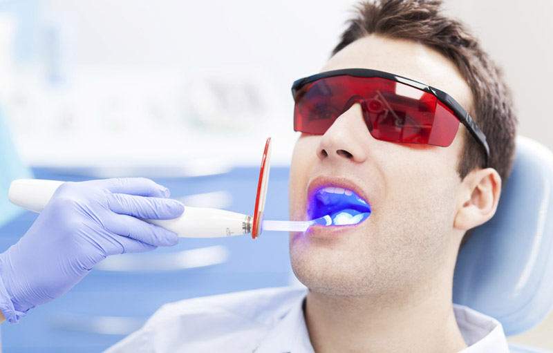 Tẩy trắng răng bằng đèn Plasma là phương pháp hiện đại được ưa chuộng