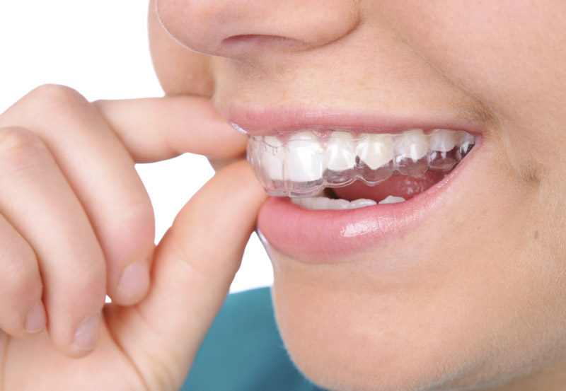 Việc tẩy trắng răng ở nhà mang lại hiệu quả từ 6 tháng - 2 năm