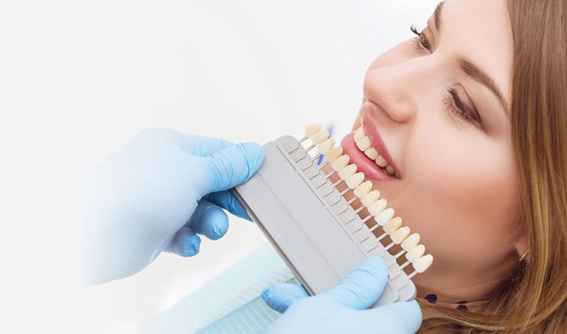 Tẩy trắng răng được bao lâu tùy vào phương pháp và cách chăm sóc 
