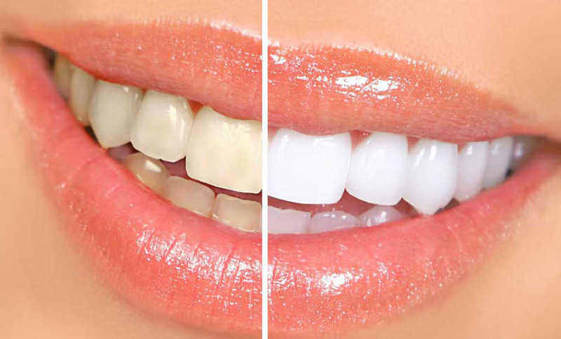 Tẩy trắng răng giá bao nhiêu phụ thuộc nhiều yếu tố