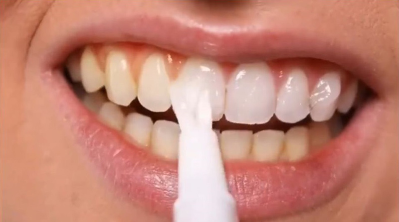 Chất lượng thuốc, sản phẩm tẩy trắng răng ảnh hưởng đến chi phí