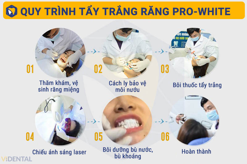 Quy trình tẩy trắng răng công nghệ Laser PRO-WHITE tại ViDental Clinic