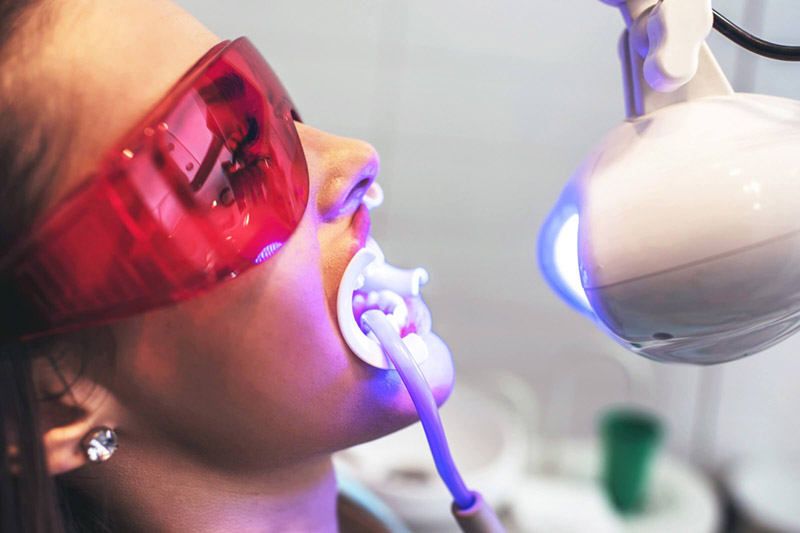 Tẩy trắng răng bằng Laser có chi phí hợp lý so với lợi ích mang lại