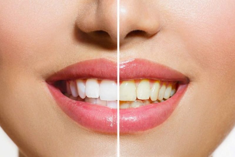 Tẩy trắng răng Laser gần như không gây hại đến sức khỏe người dùng