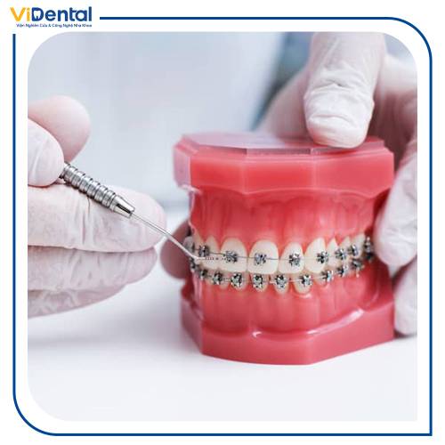 Lấy dấu răng và thiết kế mắc cài là bước vô cùng quan trọng trong quá trình niềng răng