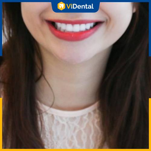 Nụ cười tự tin, xinh xắn của Minh Tú sau trải nghiệm bọc răng sứ tại ViDental Clinic