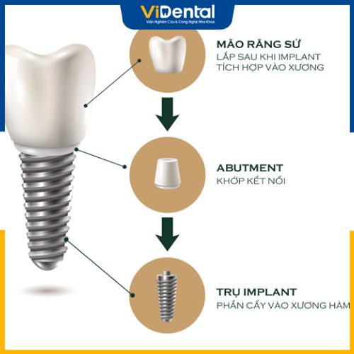 Cấu tạo hoàn chỉnh của một răng Implant
