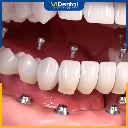 Có rất nhiều loại răng Implant từ thương hiệu khác nhau cho khách hàng lựa chọn