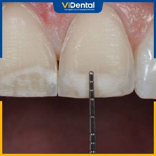 Mài răng hô nhẹ được thực hiện khá nhanh, không tốn nhiều thời gian, công sức và chi phí