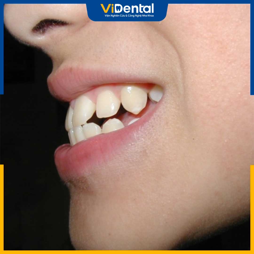 Niềng răng hô 1 hàm giá bao nhiêu phụ thuộc vào rất nhiều yếu tố như hô do răng hay hô do hàm.