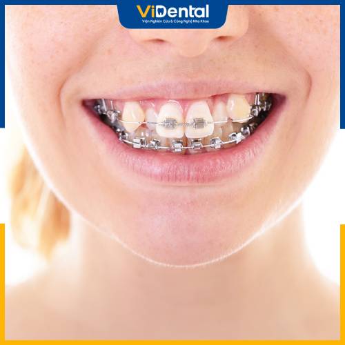 Niềng răng là giải pháp được các bác sĩ, chuyên gia khuyến cáo khi gặp tình trạng răng khấp khểnh