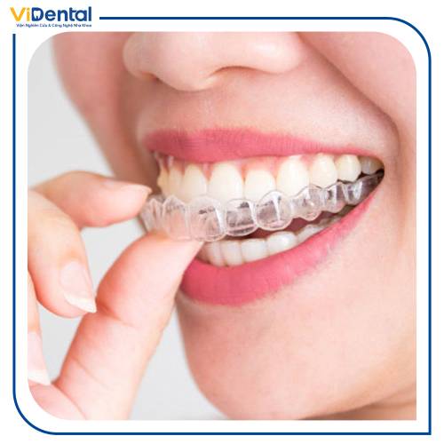 Niềng răng tháo lắp bằng khay nhựa trong suốt còn được gọi là niềng răng Invisalign