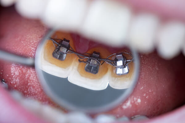 Phương pháp niềng răng mắc cài mặt trong