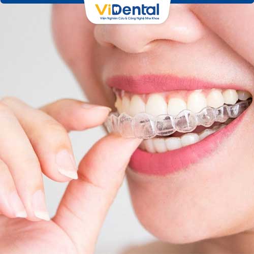 Chi phí niềng răng hô hàm không mắc cài thường giao động từ 70 – 120 triệu.