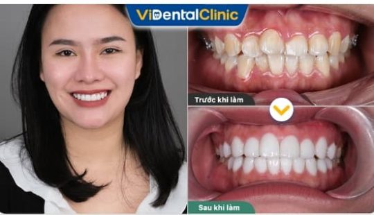 Khách hàng lựa chọn bọc răng sứ tại Trung Tâm ViDental Clinic