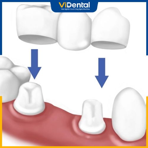 Cầu răng sứ được khá nhiều người lựa chọn để phục hình răng bị mất