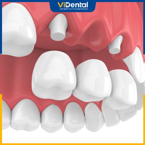 Phương pháp cầu răng sứ có nhiều ưu điểm nổi bật