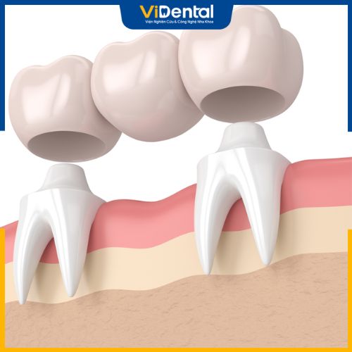 Hiện tượng tiêu xương hoàn toàn vẫn xảy ra sau khi làm cầu răng