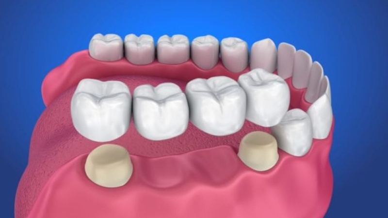 Cầu răng sứ là phương pháp thay thế răng bị mất phổ biến 