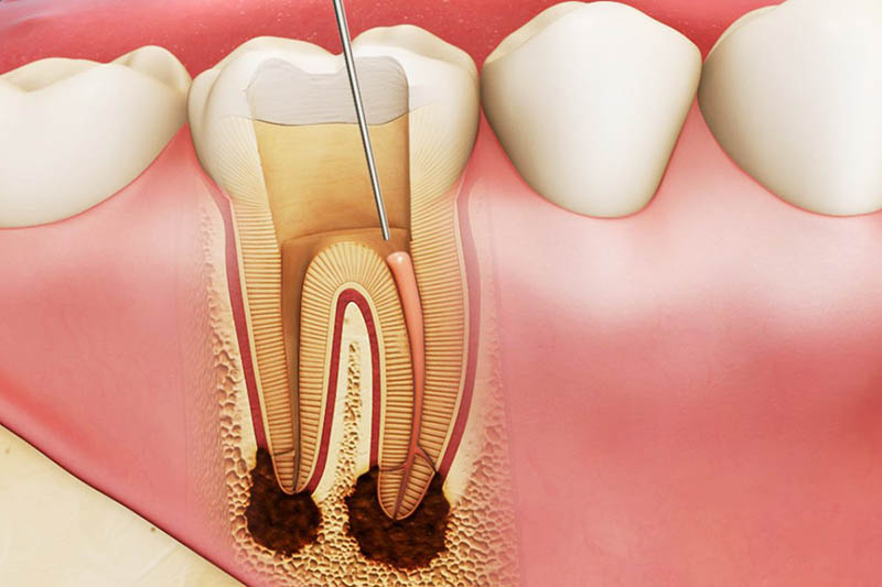 Lấy tuỷ bọc sứ răng được áp dụng cho các trường hợp răng sâu nghiêm trọng, đau nhức, viêm nhiễm nặng....