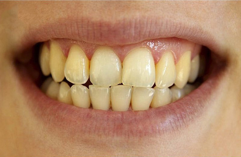 Những người có răng ố vàng có thể bọc răng để cải thiện thẩm mỹ