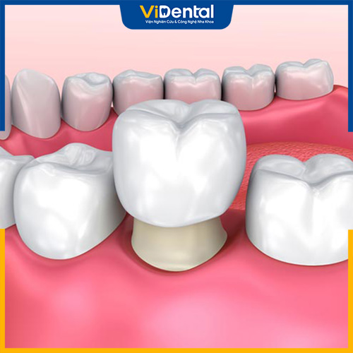Bọc răng sứ giúp bạn sở hữu hàm răng thẩm mỹ
