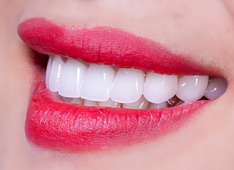 Răng sứ Lava là loại răng được nhiều khách hàng ưa chuộng hiện nay