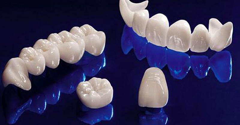 Răng toàn sứ sử dụng trong trường hợp phục hình răng sâu, răng mất