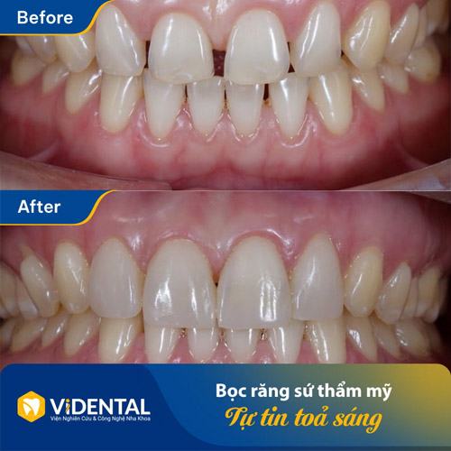 Quá trình trước và sau phục hình bọc răng sứ
