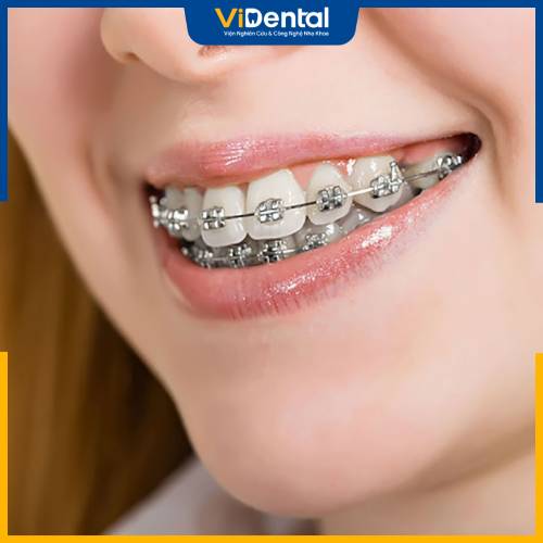 Phẫu thuật hô hàm và niềng răng lại sẽ giúp bạn khắc phục tình trạng hô, vẩu trở lại