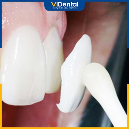 Veneer được xem là phương pháp phục hình thẩm mỹ răng toàn diện