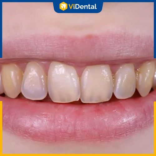 Tẩy trắng răng giúp lấy lại hàm răng trắng sáng, thẩm mỹ