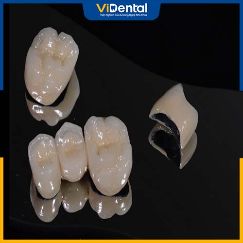 Răng sứ Inox là loại phổ biến và được nhiều sử dụng nhất hiện nay