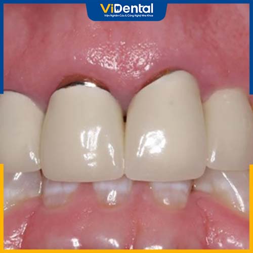 Răng sứ kim loại có nguy cơ gây đen viền nướu