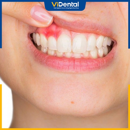 Viêm lợi sau khi bọc răng sứ là tình trạng phổ biến ở nhiều người