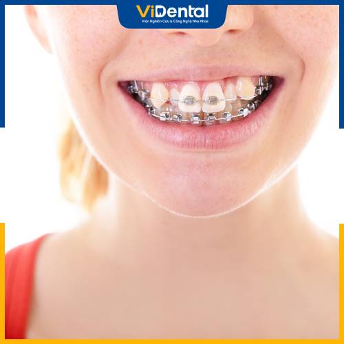 Niềng răng khểnh tăng tính thẩm mỹ và hạn chế bệnh về răng