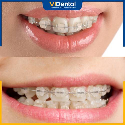 Niềng răng mắc cài pha lê phù hợp với nhiều tình trạng như răng hô, răng móm, răng thưa, khấp khểnh