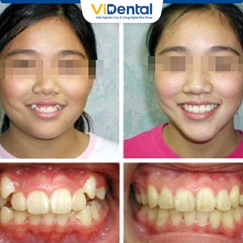 Tình trạng răng trước và sau khi chỉnh nha của bé Linh 