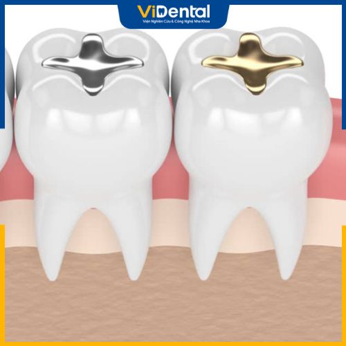 Một số phương pháp trám răng phổ biến hiện nay
